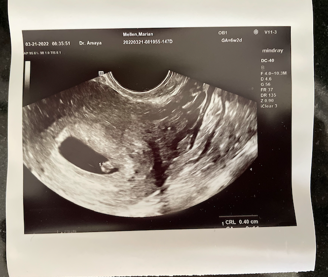 miscarried embryo at 3 weeks